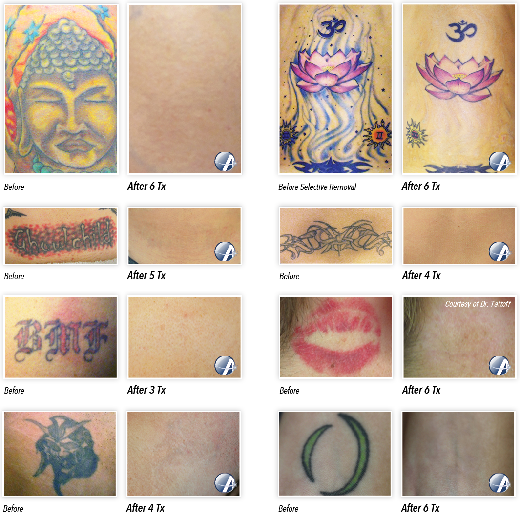 Tattoo Removal Before &amp; After Photos from Astanza