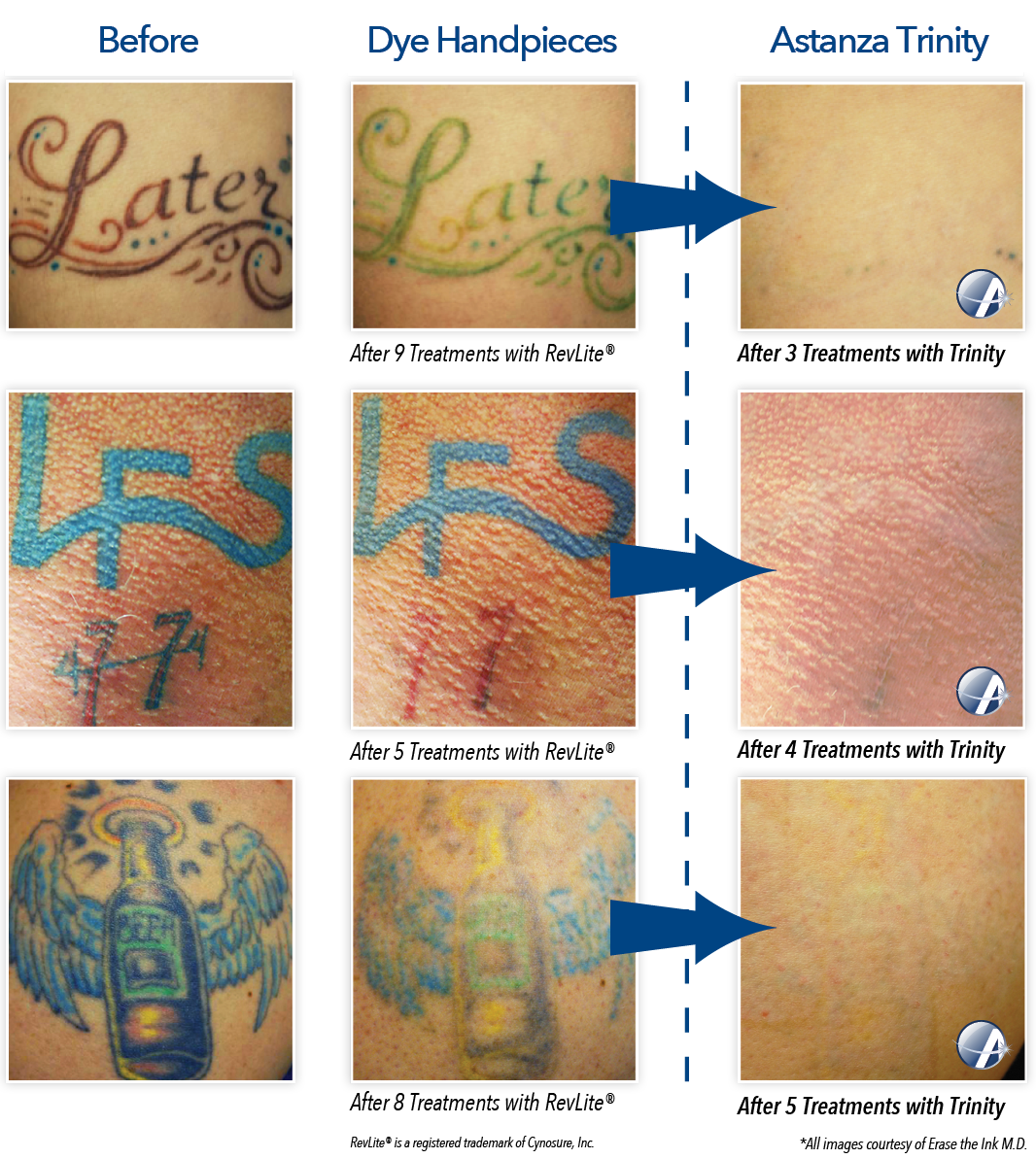 how much does it cost to get a tattoo removed in ireland tattoo how much does it cost to get a tattoo removed in ireland tattoo