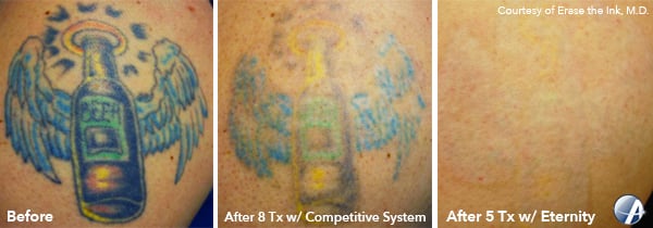 Beer-Tattoo-Removal-Before-After