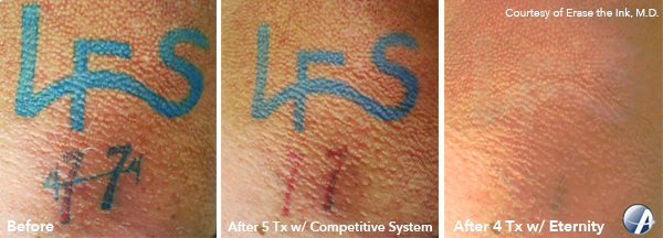 LFS-Tattoo-Removal-Photo