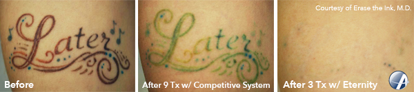 Tattoo removal a billiondollar business