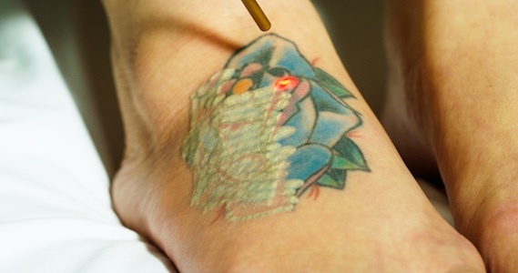 The Kirby-Desai Scale for Laser Tattoo Removal