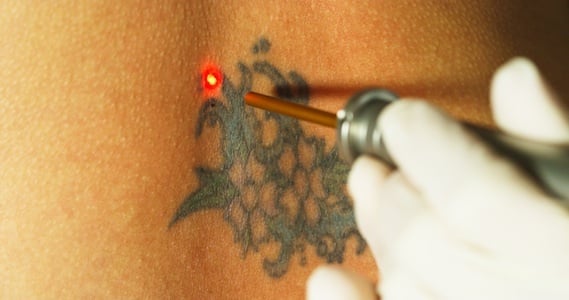 Video Millefiori skin care  tattoo removal